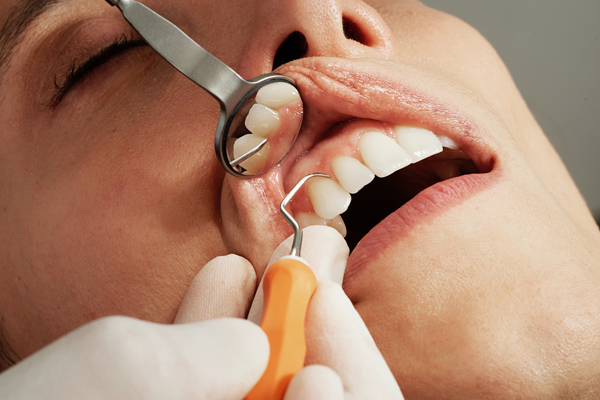 Зубочистки отменяются: стоматолог рассказала, как ухаживать за зубами летом